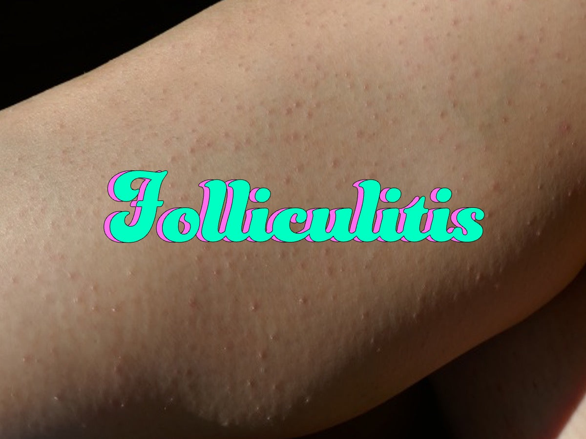 Understanding Folliculitis: Causes, Symptoms, And Treatment Strategies ...